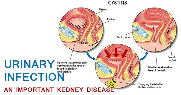 URINARY-INFECTION-AN-IMPORTANT-KEDNEY-DISEASE